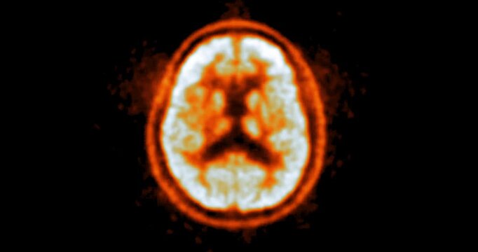 PET scan footage of the brain highlighting areas of metabolic activity, essential for diagnosing conditions like Alzheimer's, tumors, and epilepsy.