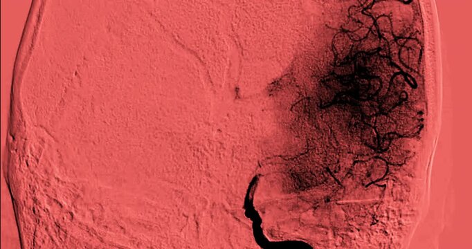 Cerebral angiography footage illustrating contrast dye movement through brain arteries, providing crucial insights into stroke, aneurysms, and vascular malformations.