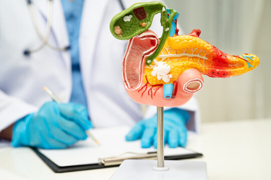 Pancreatitis, pancreatic cancer, Asian doctor with pancreas, gallbladder and bile duct human anatomy model at hospital.