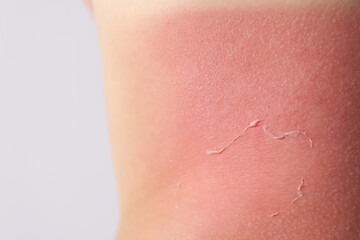 Woman with peeling skin from sunburn on light background, closeup