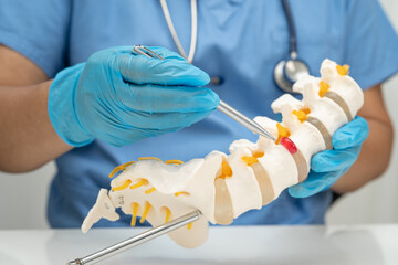Asian doctor holding spinal nerve and bone model, Lumbar spine displaced herniated disc fragment for treatment medical in the orthopedic department.