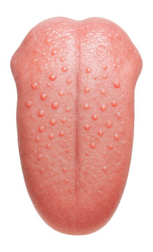 Human tongue with visible fungiform papillae scattered across the surface