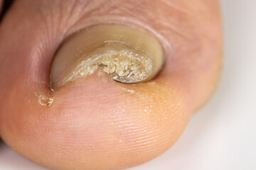 Ingrown toenail on a senior feet with white background
Close-up ingrown toenail on senior feet with...