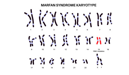 Marfan syndrome poster
