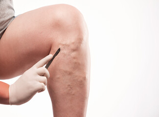 doctor shows  the dilation of small blood vessels of the skin on the leg. Medical inspection and...