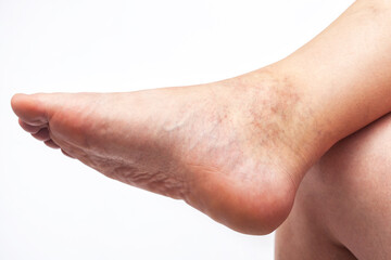 An orthopedic doctor does massage of the foot and lower leg of the patient after an injury Sprained...