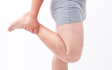 doctor shows  the dilation of small blood vessels of the skin on the leg. Medical inspection and...