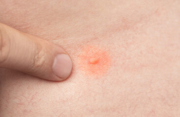 Fototapeta premium A mosquito bites a person in the stomach. The insect bit through the skin.