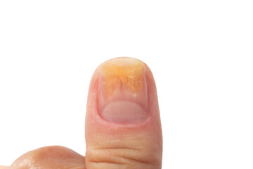 Psoriasis at the nail. Psoriasis is an autoimmune disease that affects the skin and nails. Close up