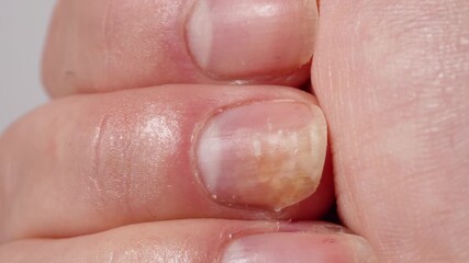 Psoriasis at the nail. Psoriasis is an autoimmune disease that affects the skin and nails. Close up