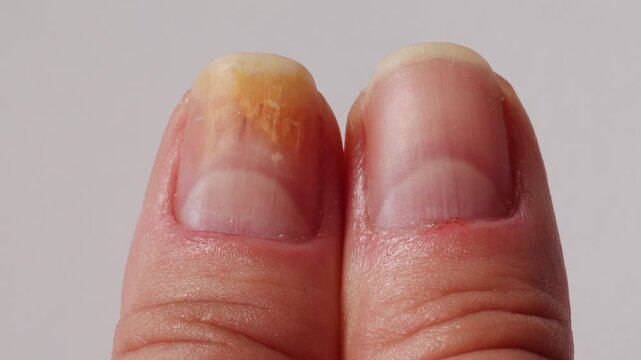 Psoriasis at the nail. Psoriasis is an autoimmune disease that affects the skin and nails. Close up