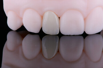Lateral maxillary incisor made of zirconium, ultra thin dental ceramic veneer crown on printed model