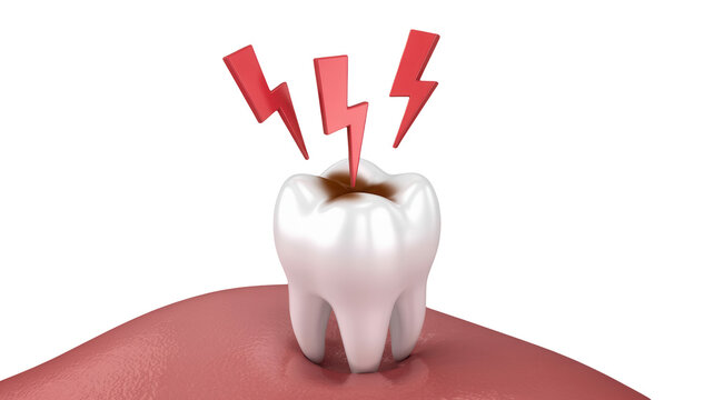 Toothache agony with painful decay, dentist visit needed for urgent care, dental health concern, tooth decay crisis, oral hygiene emergency, lightning bolts pain