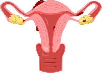Endometriosis 