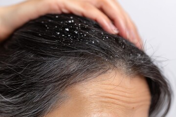 Obraz premium Scalp Condition Dandruff Problem