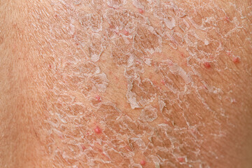 Dangerous sunburn. The shoulders and spine of caucasian man. Men with sun damaged peeling skin on the back. Peeling skin from a sunburn. Skin and Body Care. Sun protection.