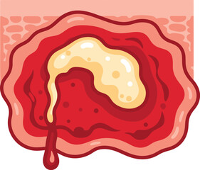 A stylized illustration of a wound with yellowish pus and blood.
