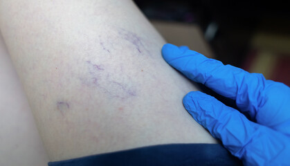 Close-up image of spider veins on a woman’s leg during a medical examination. Visible varicose...