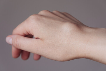 Female right back hand with ganglion cyst on the dorsum,  fluid-filled bump associated with a joint or tendon sheath, close-up view, selected focus.