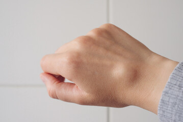 Female right back hand with ganglion cyst on the dorsum,  fluid-filled bump associated with a joint or tendon sheath, close-up view, selected focus.
