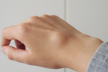 Female right back hand with ganglion cyst on the dorsum,  fluid-filled bump associated with a joint or tendon sheath, close-up view, selected focus.