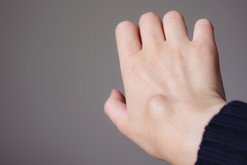 Female right back hand with ganglion cyst on the dorsum,  fluid-filled bump associated with a joint or tendon sheath, close-up view, selected focus.