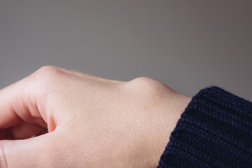 Female right back hand with ganglion cyst on the dorsum,  fluid-filled bump associated with a joint or tendon sheath, close-up view, selected focus.