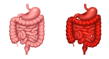 Healthy versus inflamed digestive system; comparison of normal and irritated intestines.