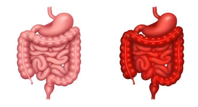 Healthy versus inflamed digestive system; comparison of normal and irritated intestines.