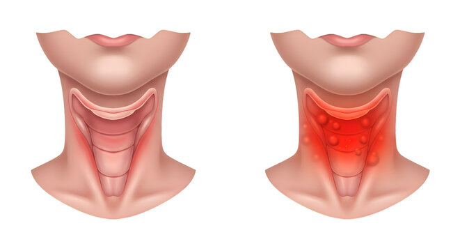 Medical illustration comparing a healthy thyroid gland to an enlarged goiter with inflamed nodules.