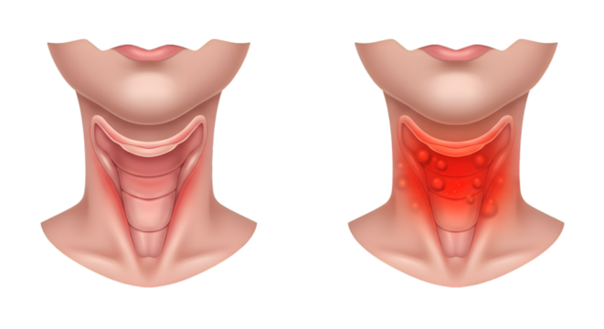 Medical illustration comparing a healthy thyroid gland to an enlarged goiter with inflamed nodules.
