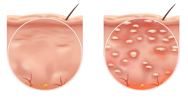 Detailed medical illustration comparing healthy skin to skin affected by a condition.