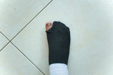 A foot wearing a sock with a hole in the toe