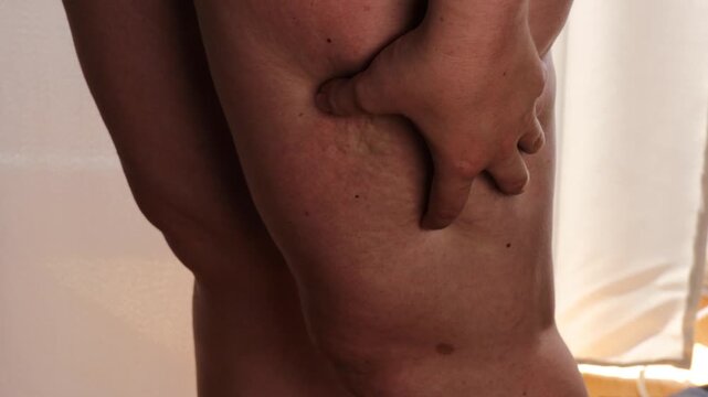 legs with visible cellulite texture closeup under daylight showing natural skin body appearance concept of bodycare and wellness indoors