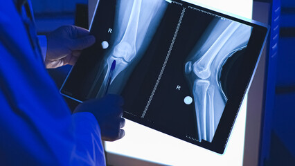 X-ray of the leg. X-ray close-up. X-ray image.High-quality photo. © Vladimir