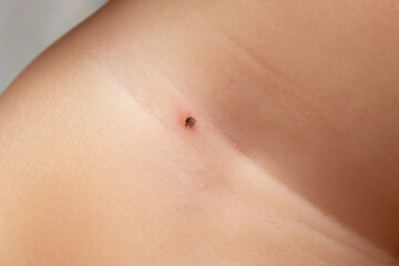 Fototapeta premium Mite dug into the skin of a small child, the danger of the summer in the woods