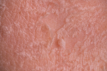 Skin shedding and regeneration close-up – Dermatology concept – Peeling human skin