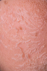 Skin shedding and regeneration close-up – Dermatology concept – Peeling human skin