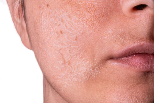 Woman peeling facial skin – Skincare treatment concept – Female face with flaky skin after exfoliation