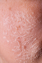 Skin shedding and regeneration close-up – Dermatology concept – Peeling human skin