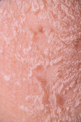 Skin shedding and regeneration close-up – Dermatology concept – Peeling human skin