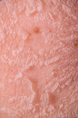 Skin shedding and regeneration close-up – Dermatology concept – Peeling human skin