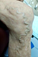 Varicose veins in the leg of an elderly person, circulation issues, cardiovascular problems