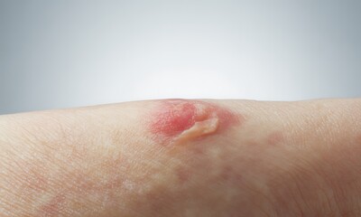 Fototapeta premium Close-Up Image of a Skin Lesion on Human Forearm Illustrating the Effects of Dermatitis or Skin Irritation with Redness, Swelling, and Scabbing for Medical Education Purposes