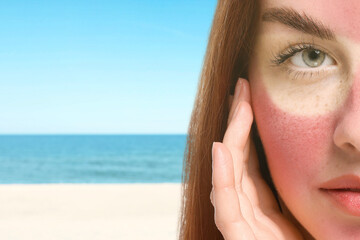 Woman with sunburned skin on beach, closeup. Red face with marks from sunglasses