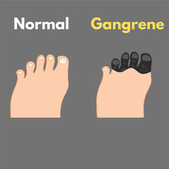 leg gangrene comparison medical illustration leg disease dead tissue due to lack of blood flow.eps