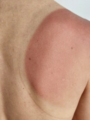 Fototapeta premium Sunburn on shoulder after a day at the beach highlighting skin damage from sun exposure concept