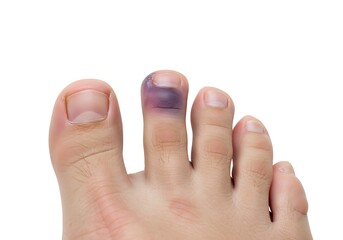 Swollen Toes With Bruising On White Background