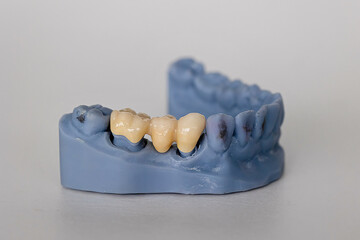 Close-up of a plastic dental model with zirconia bridge on teeth 4 to 6. Concept of fixed prosthetics, tooth replacement, and modern restorative dentistry.