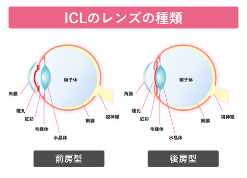 ICLのレンズの種類